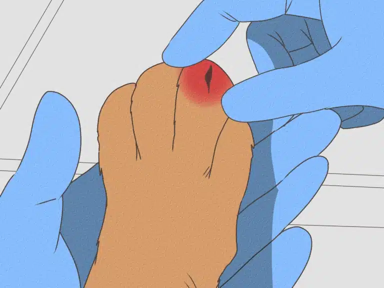 Руки в синіх рукавичках тримають коричневу лапку із запаленням на пальці